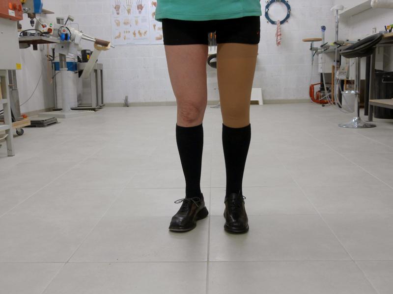 esthétique prothèse fémorale