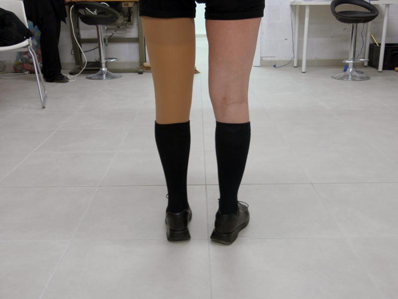 esthétique prothèse fémorale