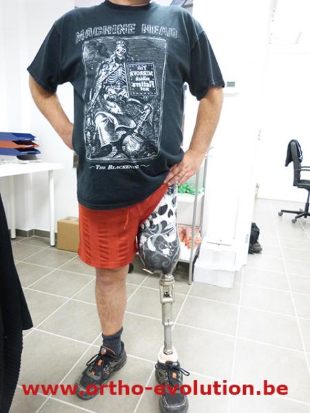 emboiture fémorale personnalisée