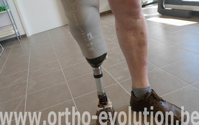 tibiale par dépression 1